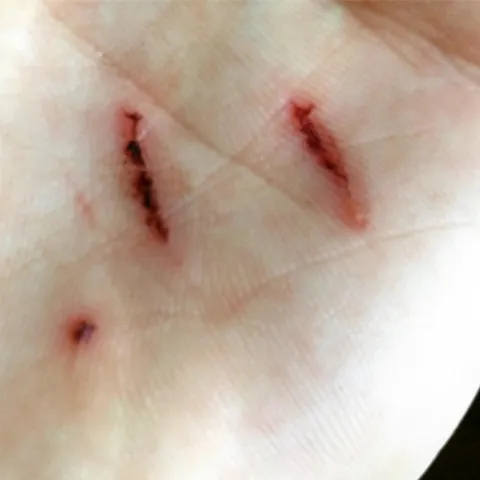 3 Scratches on Hand